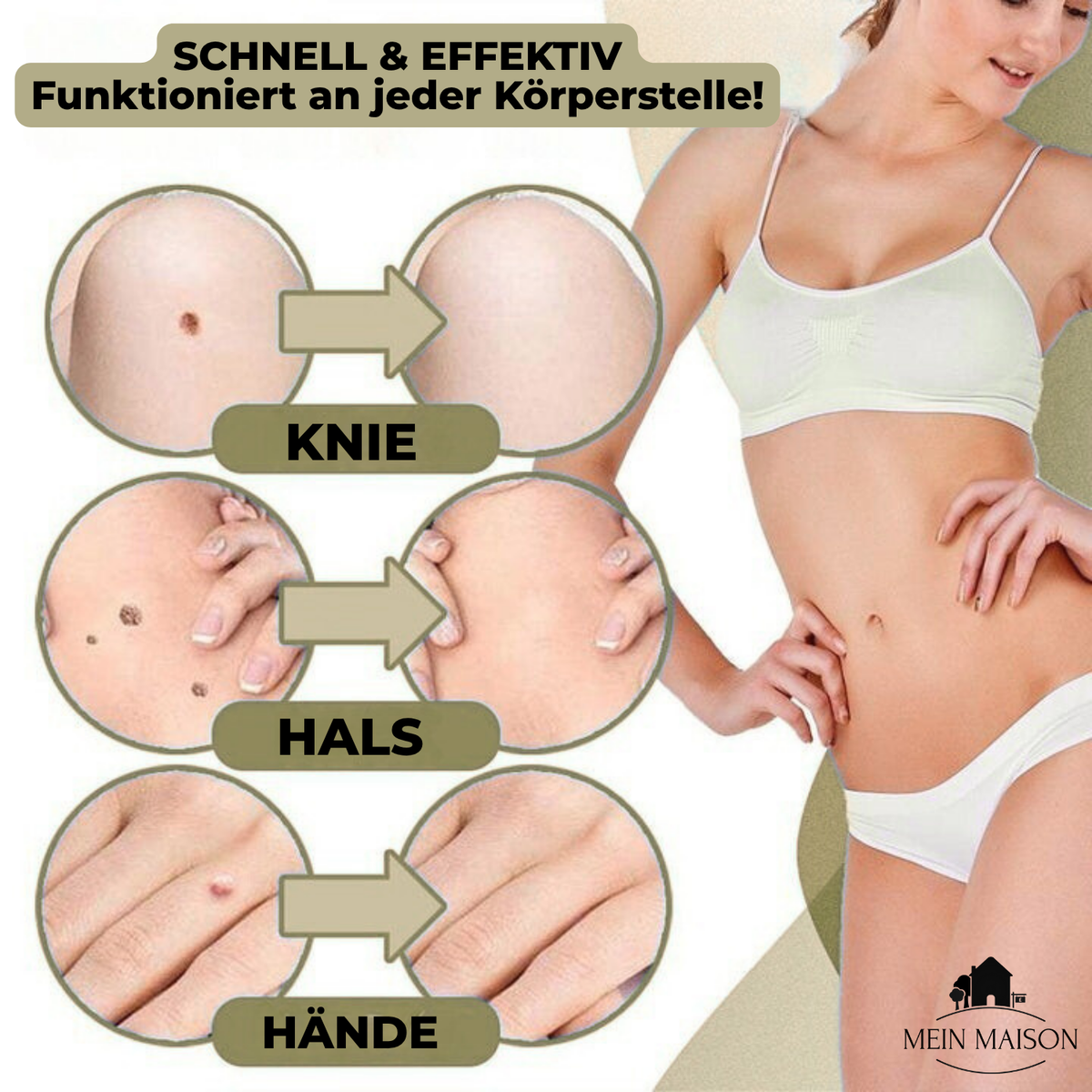 Dayhills | DermaLinx Wart Remover | Pain-Free Removal of Warts & Moles | For Home | Without Surgery