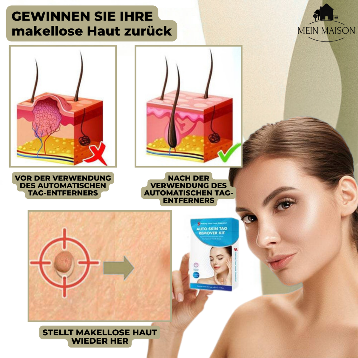 Dayhills | DermaLinx Wart Remover | Pain-Free Removal of Warts & Moles | For Home | Without Surgery