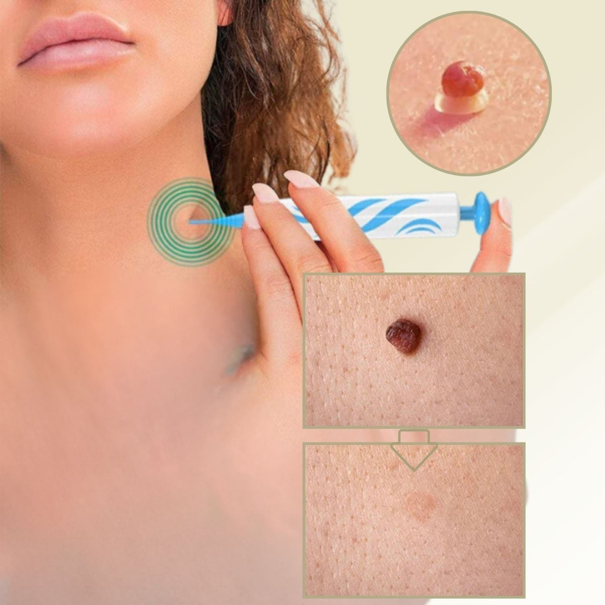 Dayhills | DermaLinx Wart Remover | Pain-Free Removal of Warts & Moles | For Home | Without Surgery