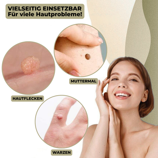 Dayhills | DermaLinx Wart Remover | Pain-Free Removal of Warts & Moles | For Home | Without Surgery