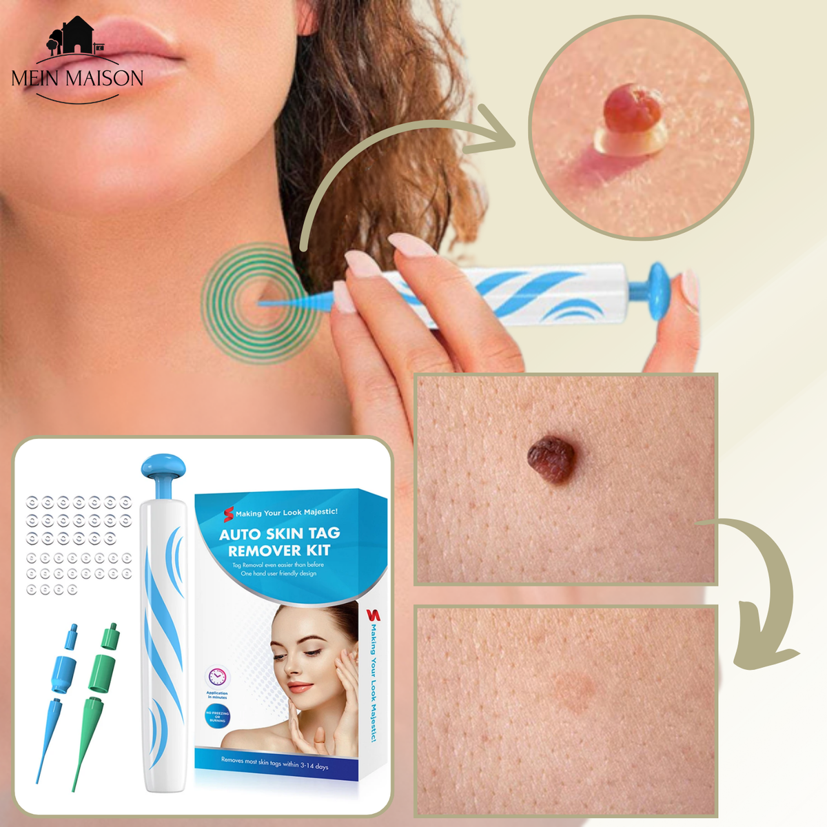 Dayhills | DermaLinx Wart Remover | Pain-Free Removal of Warts & Moles | For Home | Without Surgery